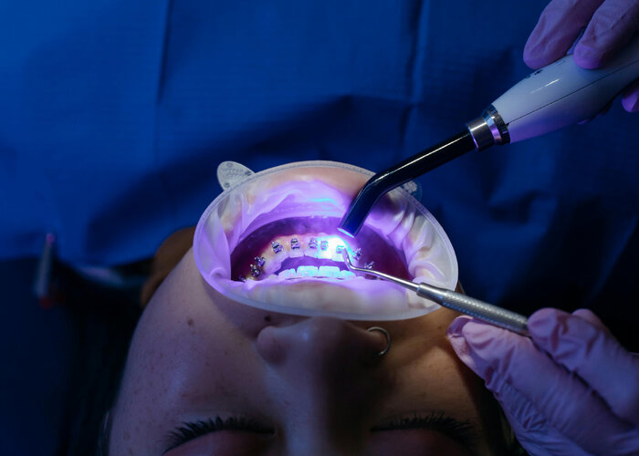 What really happens to teeth while wearing braces or aligners?